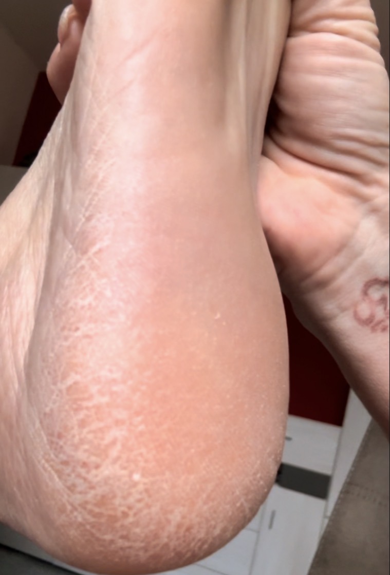 Mom's cracked heels before using Molosoc